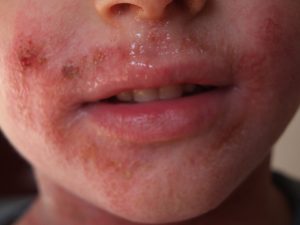 Dermatite atopica di Gioele 1