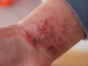 Dermatite atopica Gioele 2